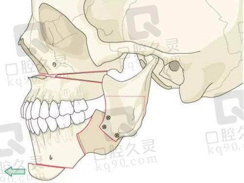 重症骨性错颌畸形1