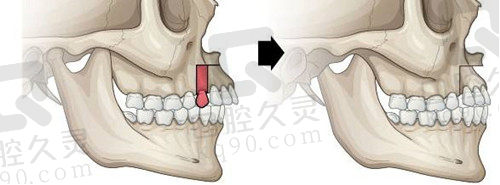 正颌手术3