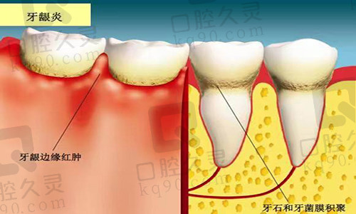 牙龈炎