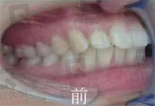 徐州美奥口腔矫正牙前侧面照