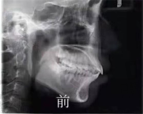 徐州美奥口腔矫正牙前CT照