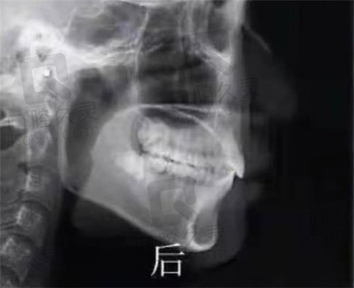 徐州美奥口腔矫正牙后CT照
