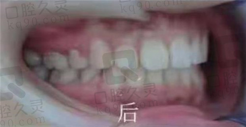 徐州美奥口腔矫正牙后侧面照