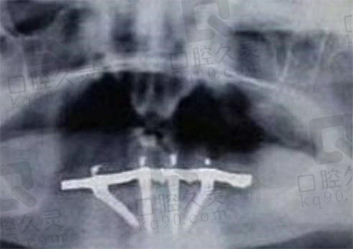 80岁老人郑州美奥口腔种植牙CT照