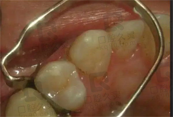 根管治疗