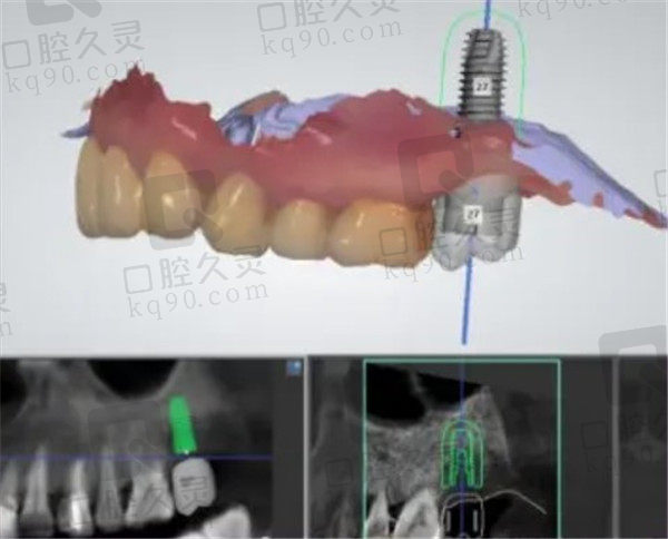 数字化种植牙优势
