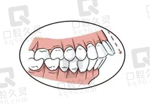 牙齿倾斜