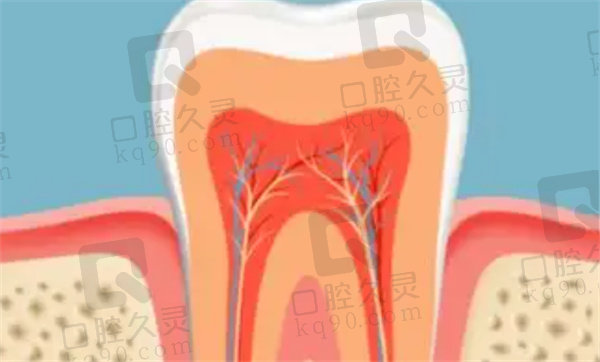 根管治疗