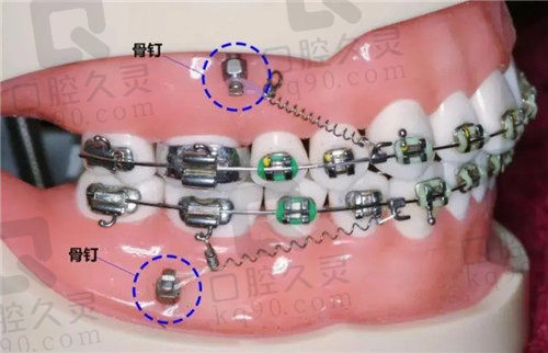 万州牙博士口腔疑难性牙齿矫正方式