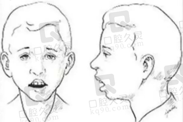 口呼吸腺体面容