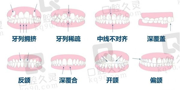 需要做矫正的牙齿类型