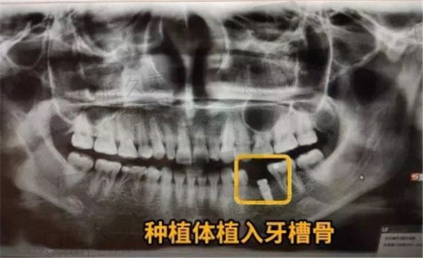 北京圣贝口腔种植牙单颗植入后CT照