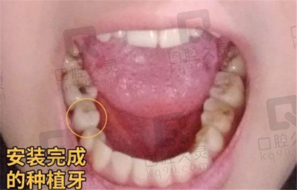 北京圣贝口腔种植牙单颗术后