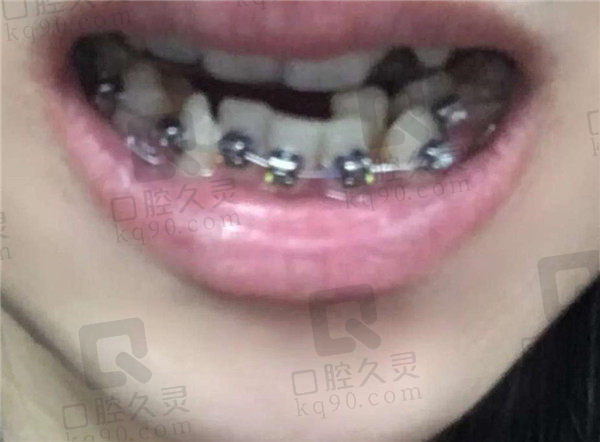 上海伊尔意口腔矫正牙刚戴上牙套 上海伊尔意口腔矫正牙刚戴上牙套