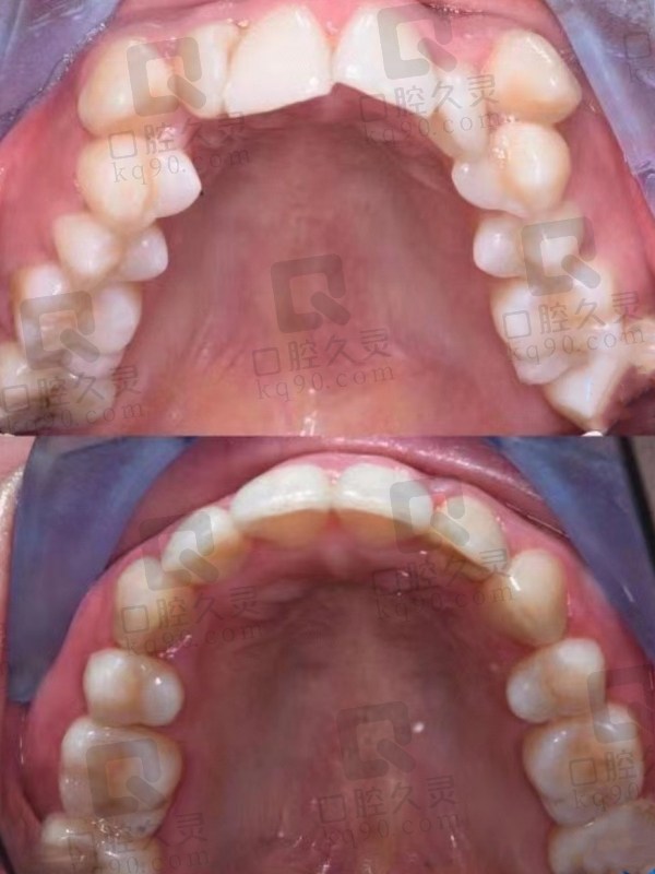 矫正前后上颌对比