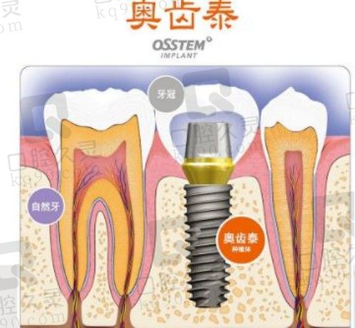 奥齿泰种植牙