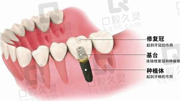 种植牙齿
