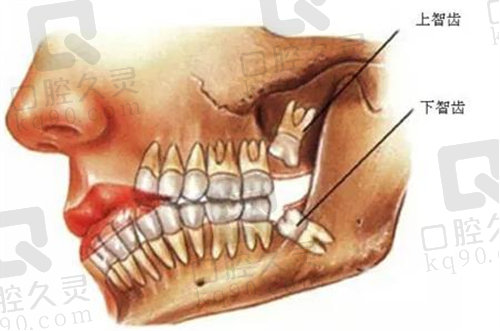 上颌正位智齿和下颌正位智齿