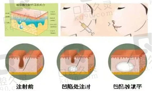 玻尿酸注射