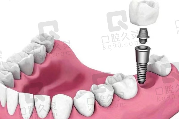 种植牙示意图