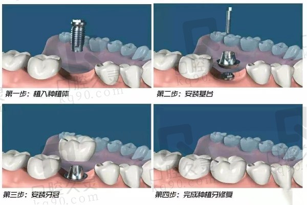 种植牙过程