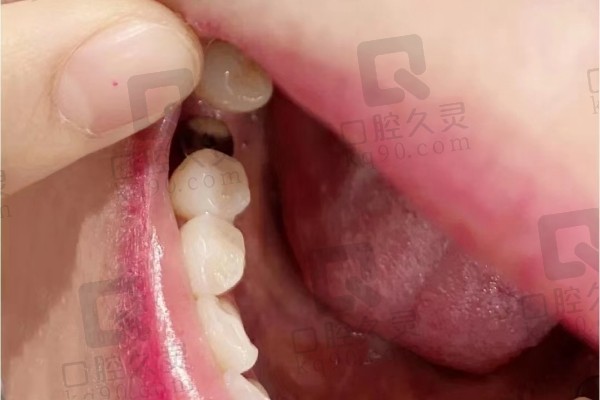 种植体时期牙齿