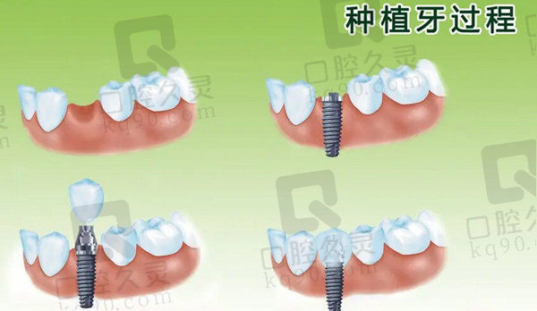 种植牙过程