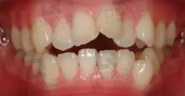 牙齿矫正前