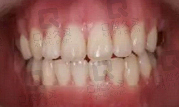 牙齿矫正后