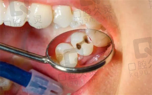 补牙（常用树脂材料）