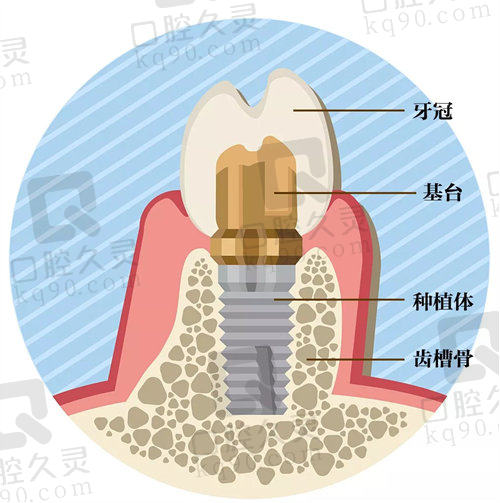 种植牙
