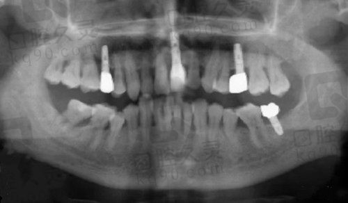 武汉清华阳光口腔种植牙术后CT