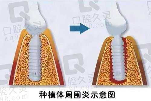 种植体周围炎