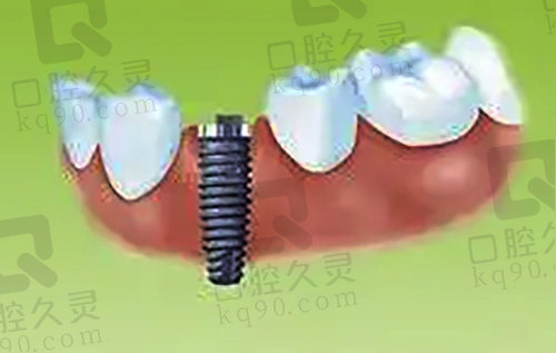 牙齿单颗种植修复