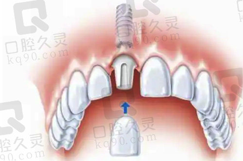 种植牙缺失修复