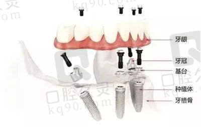 半口种植牙