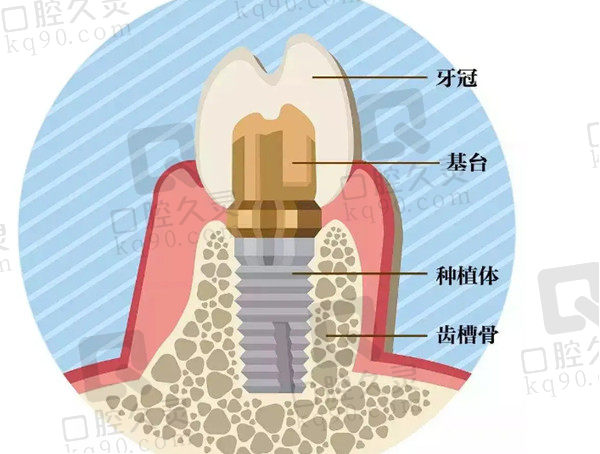 种植牙过程