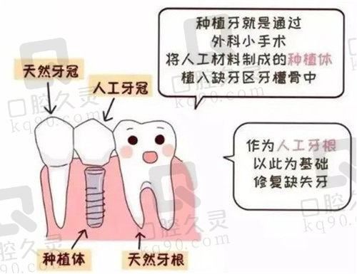 种植牙镶牙优势