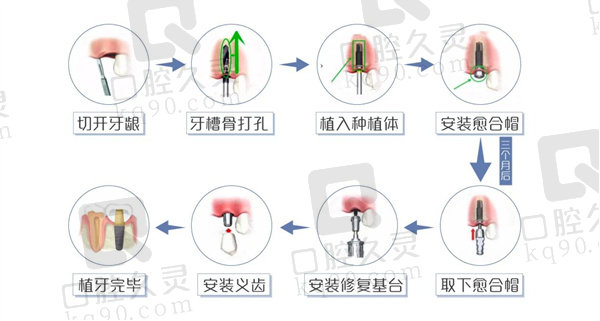 种植牙流程图