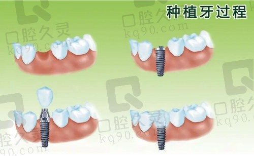 厦门登特口腔种植牙技术不错