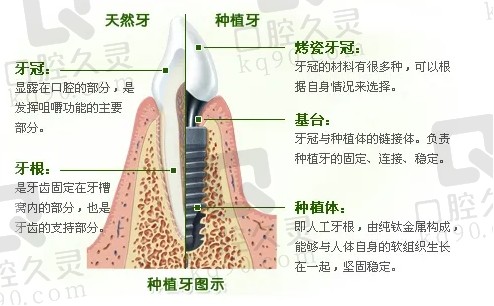 厦门登特口腔种植牙口碑好