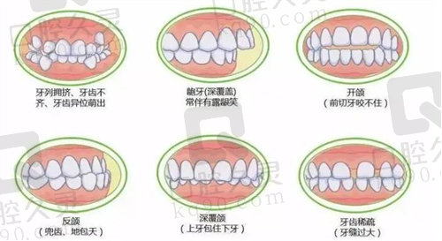 需要矫正的几种情况