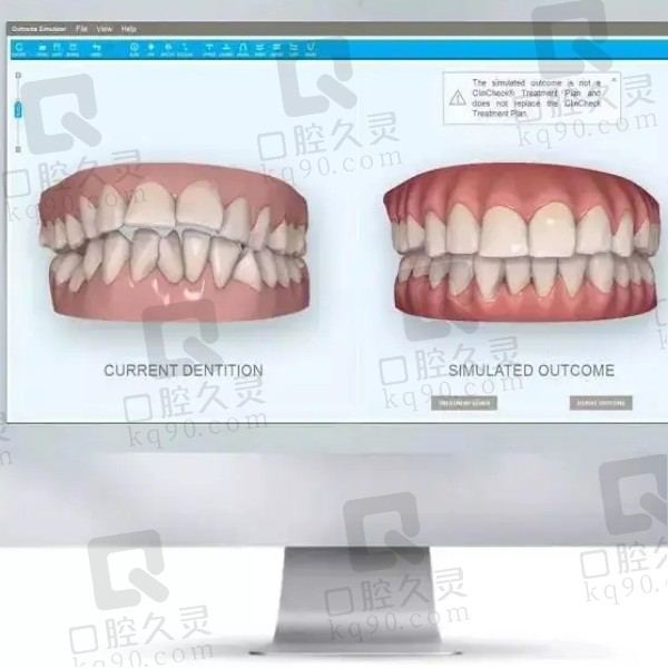 隐形矫正口扫方案模拟