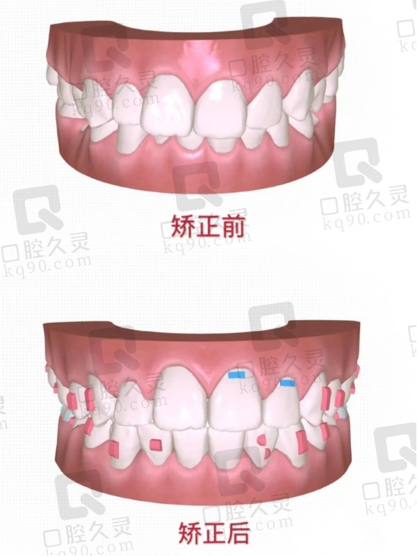 矫正方案设计