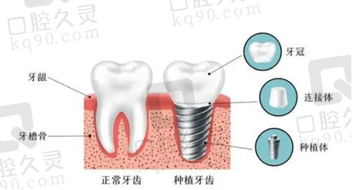 杭州西湖口腔医院种植牙