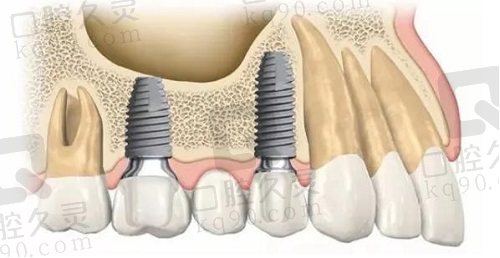 种植牙示意