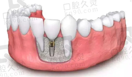 上海松丰口腔种植牙价格表