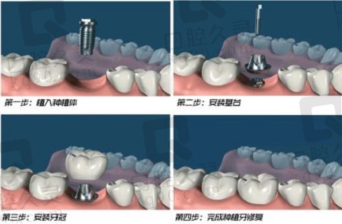 种植牙示意图