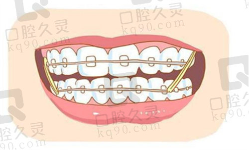 牙齿矫正