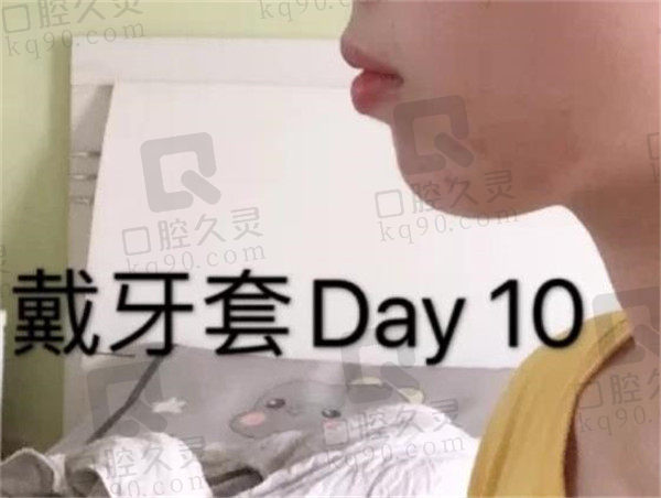 上海维乐口腔矫正牙齿10天后